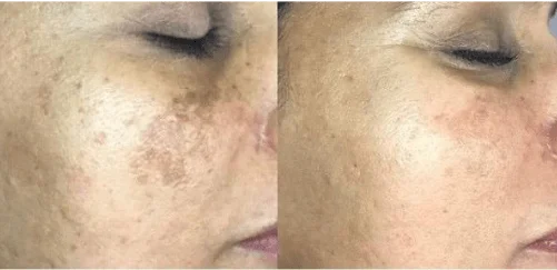 pigmentation gallery one
