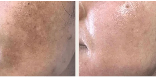 pigmentation gallery two